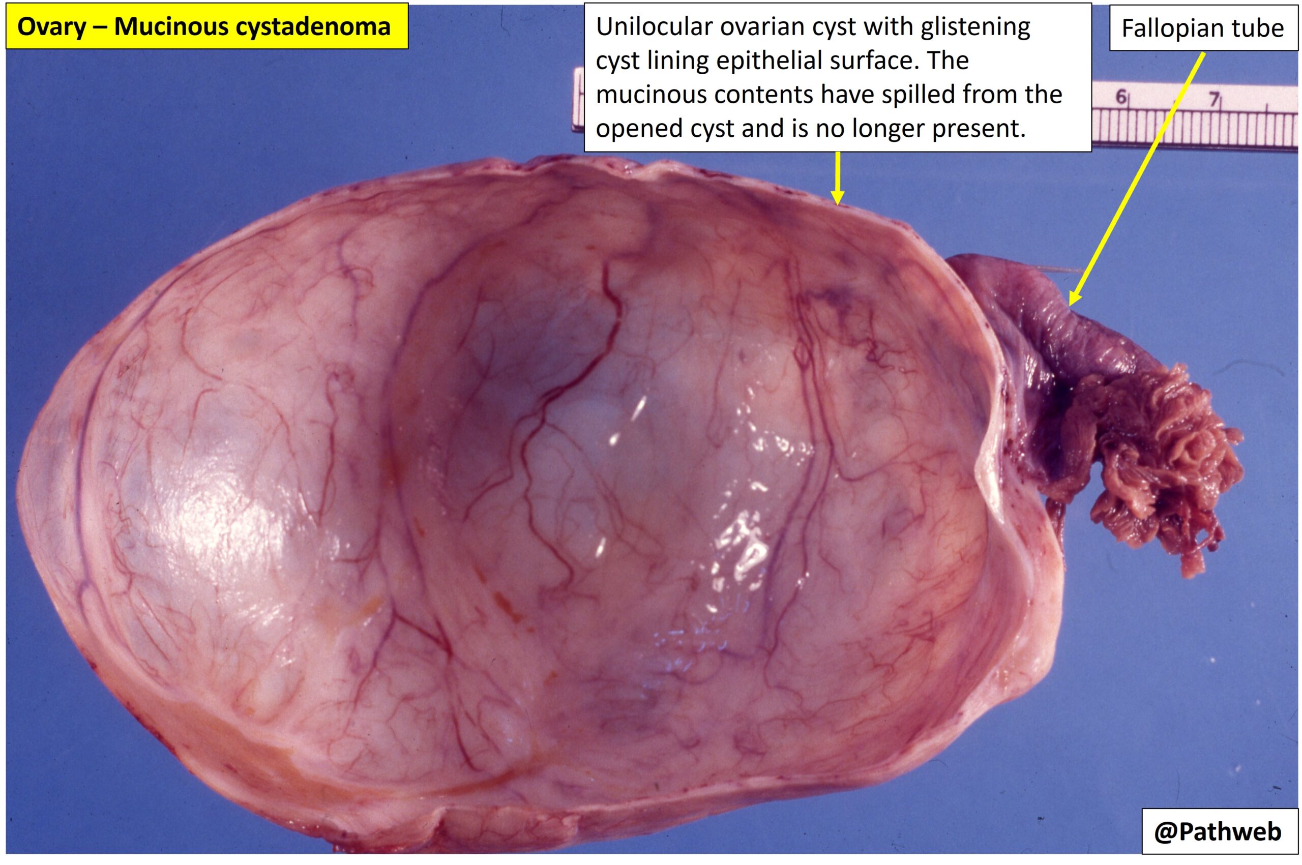 mucinous ovarian cyst