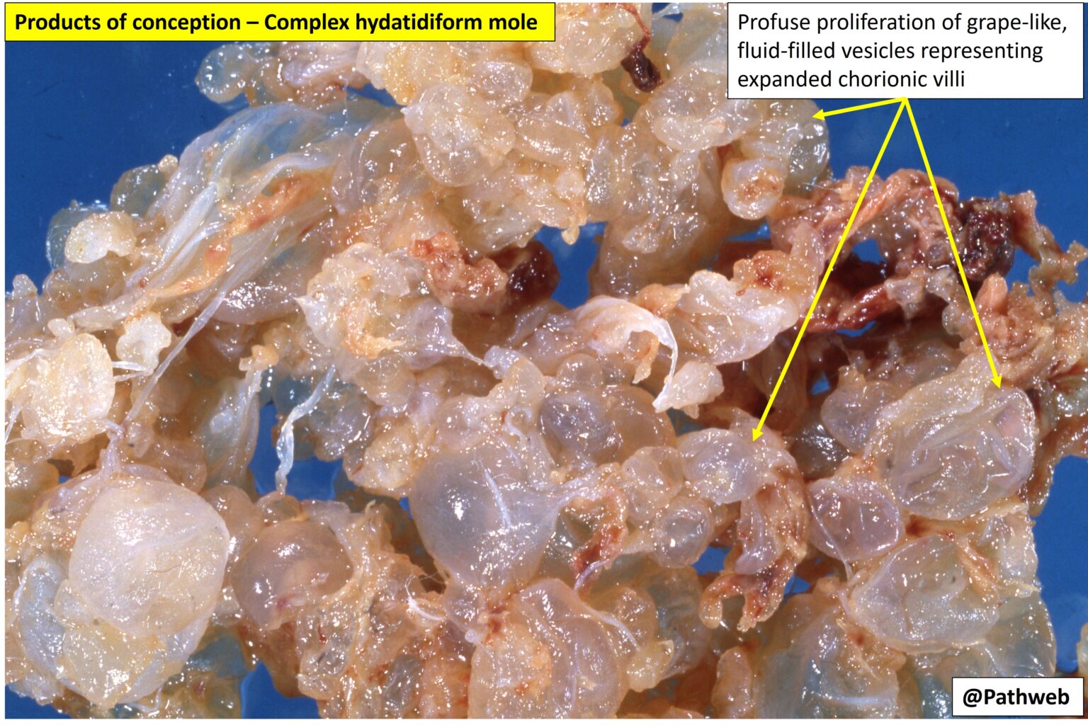 Uterus And Placenta Hydatidiform Mole Nus Pathweb Nus Pathweb