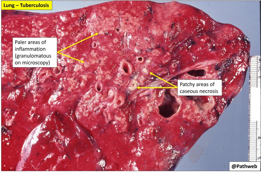 Lung Tuberculosis Nus Pathweb Nus Pathweb