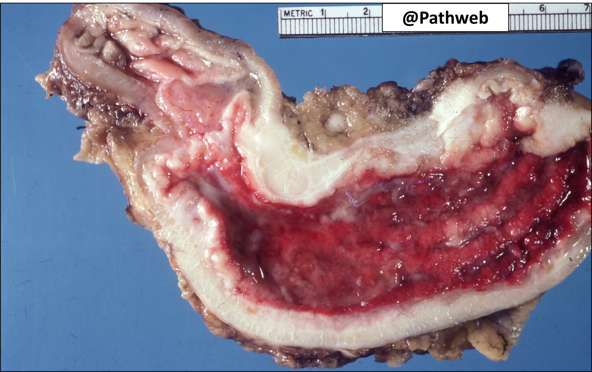 Stomach Carcinoma Linitis Plastica Nus Pathweb Nus Pathweb