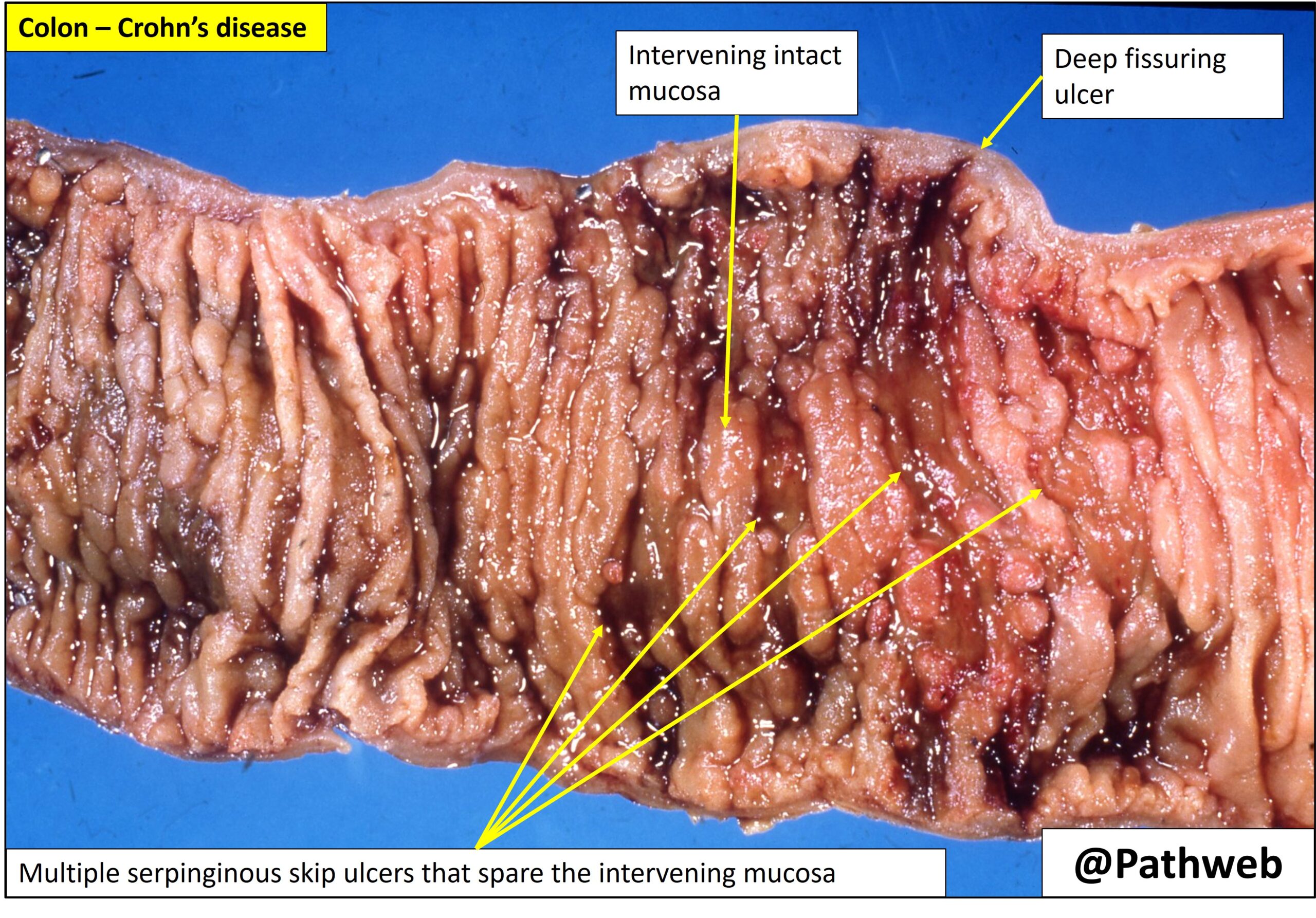 Colon – Crohn's Disease – NUS Pathweb :: NUS Pathweb