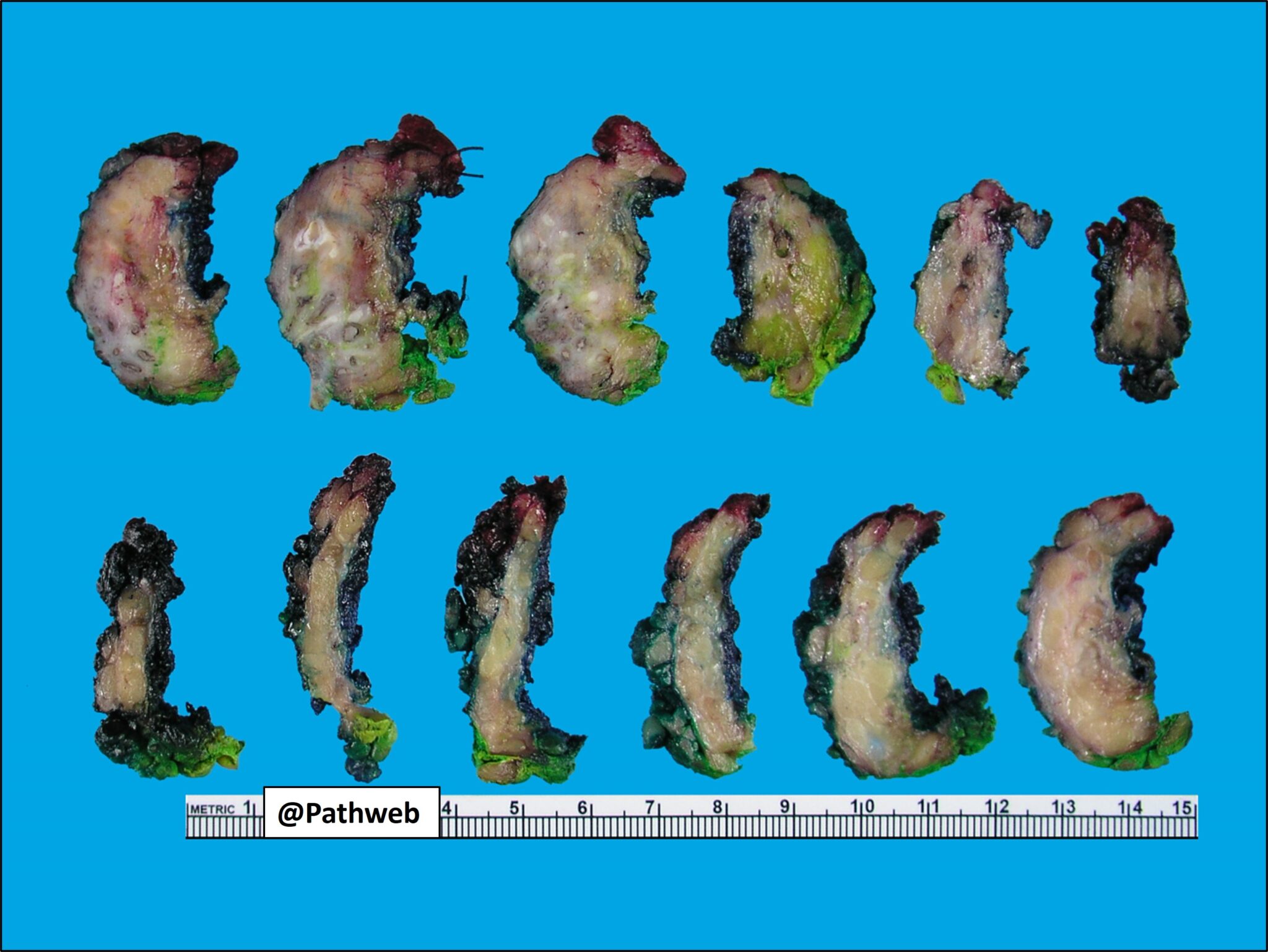 Breast Male Gynaecomastia Nus Pathweb Nus Pathweb