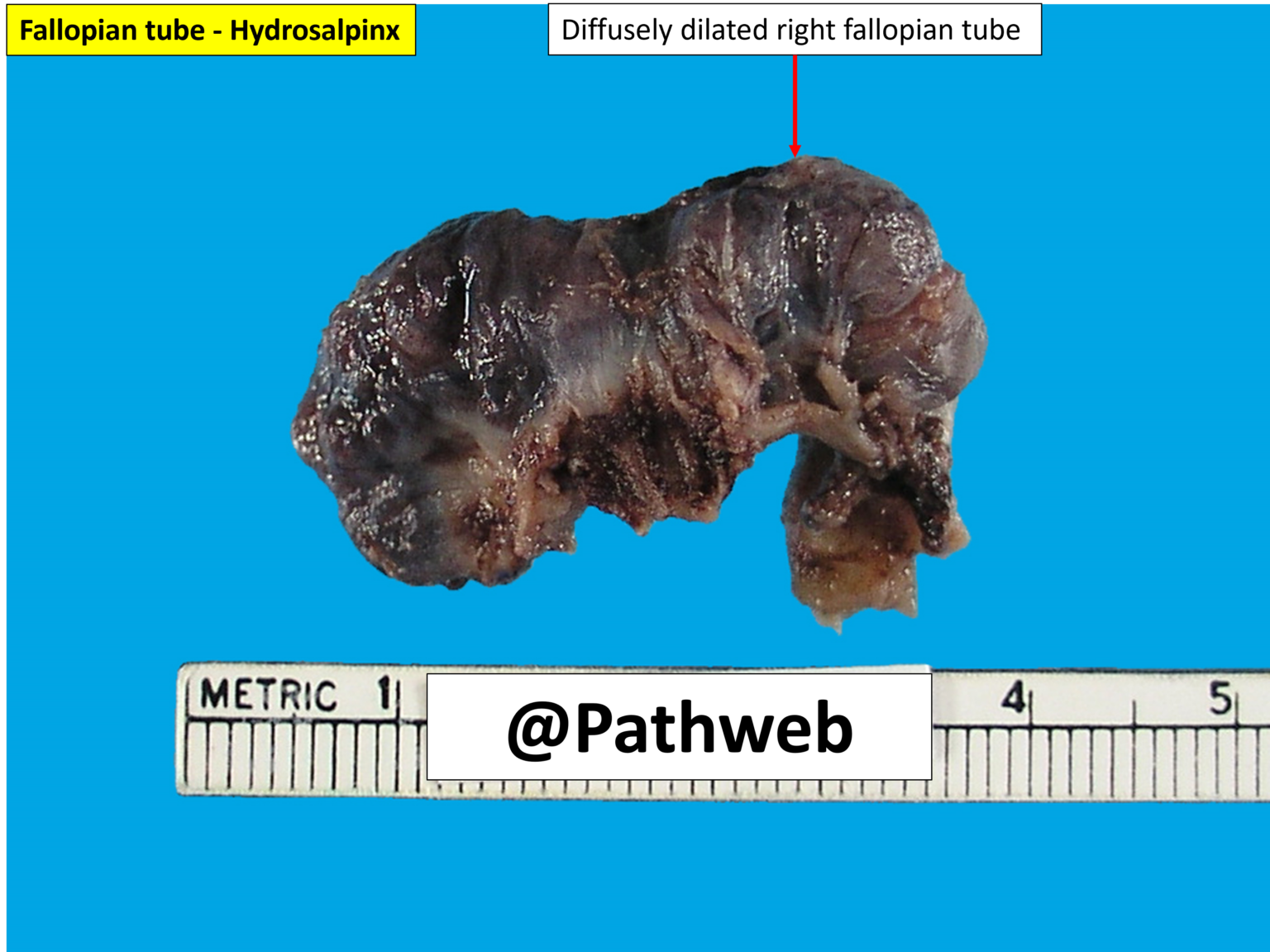 Fallopian Tube – Hydrosalpinx – NUS Pathweb :: NUS Pathweb