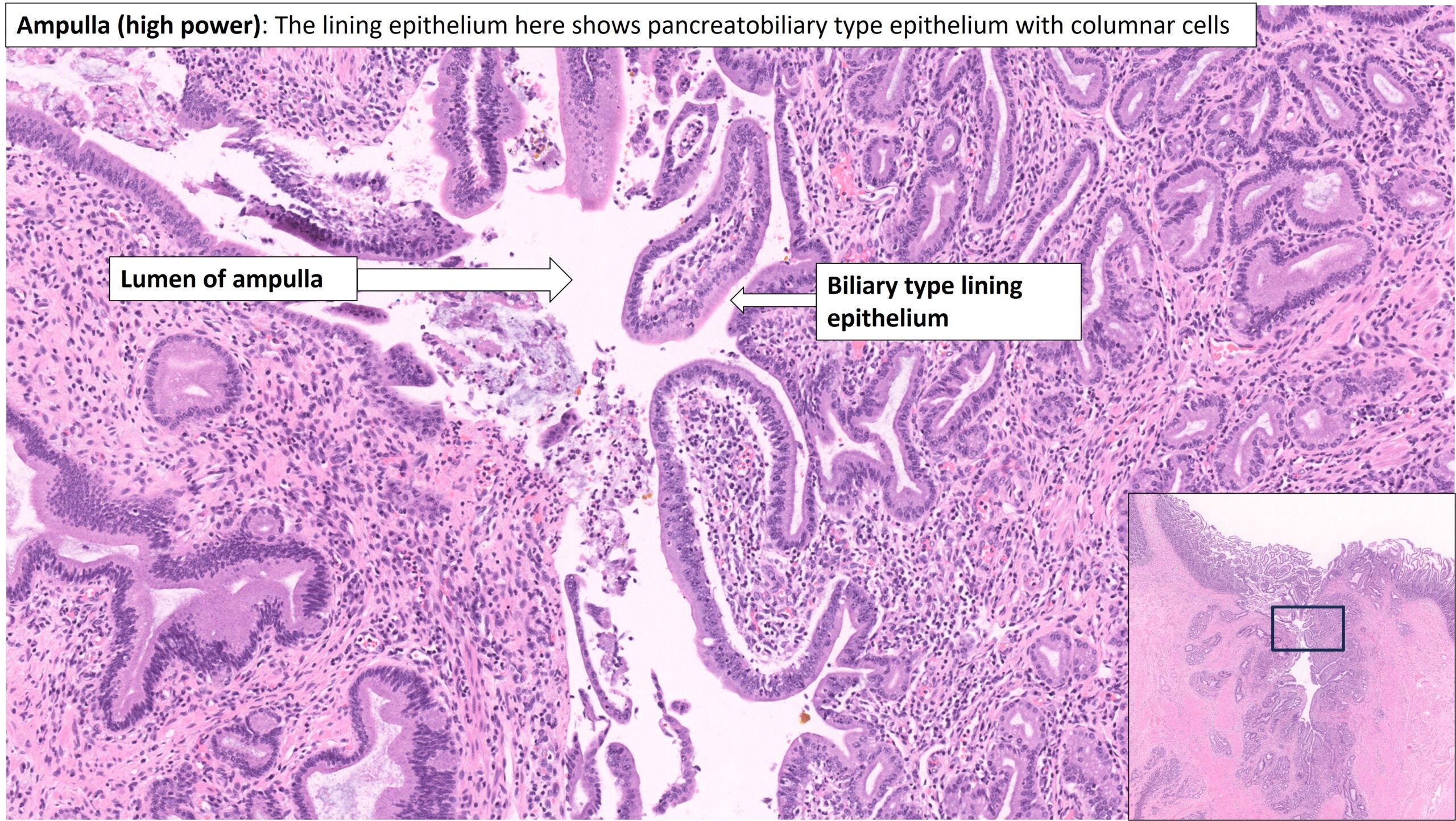 Ampulla Of Vater Histology Ampullary Adenoma