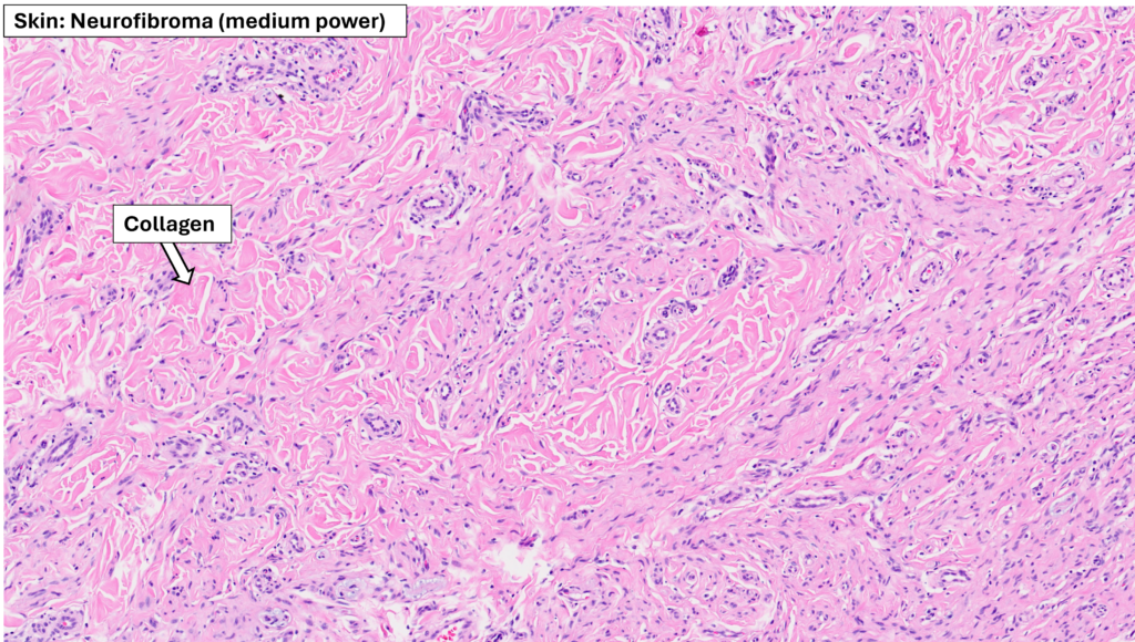 Skin – Neurofibroma – NUS Pathweb :: NUS Pathweb