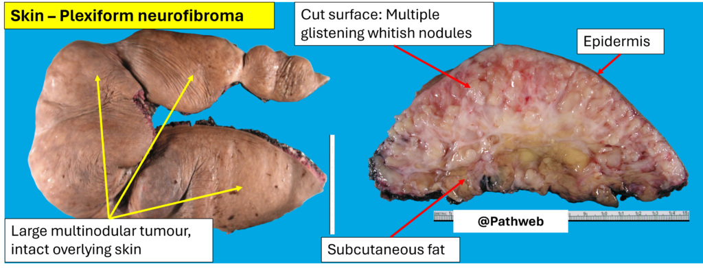 Skin – Neurofibroma – NUS Pathweb :: NUS Pathweb