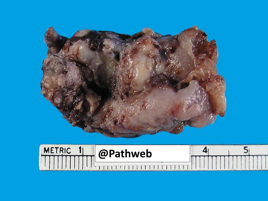 Ovary Endometriotic Cyst Nus Pathweb Nus Pathweb