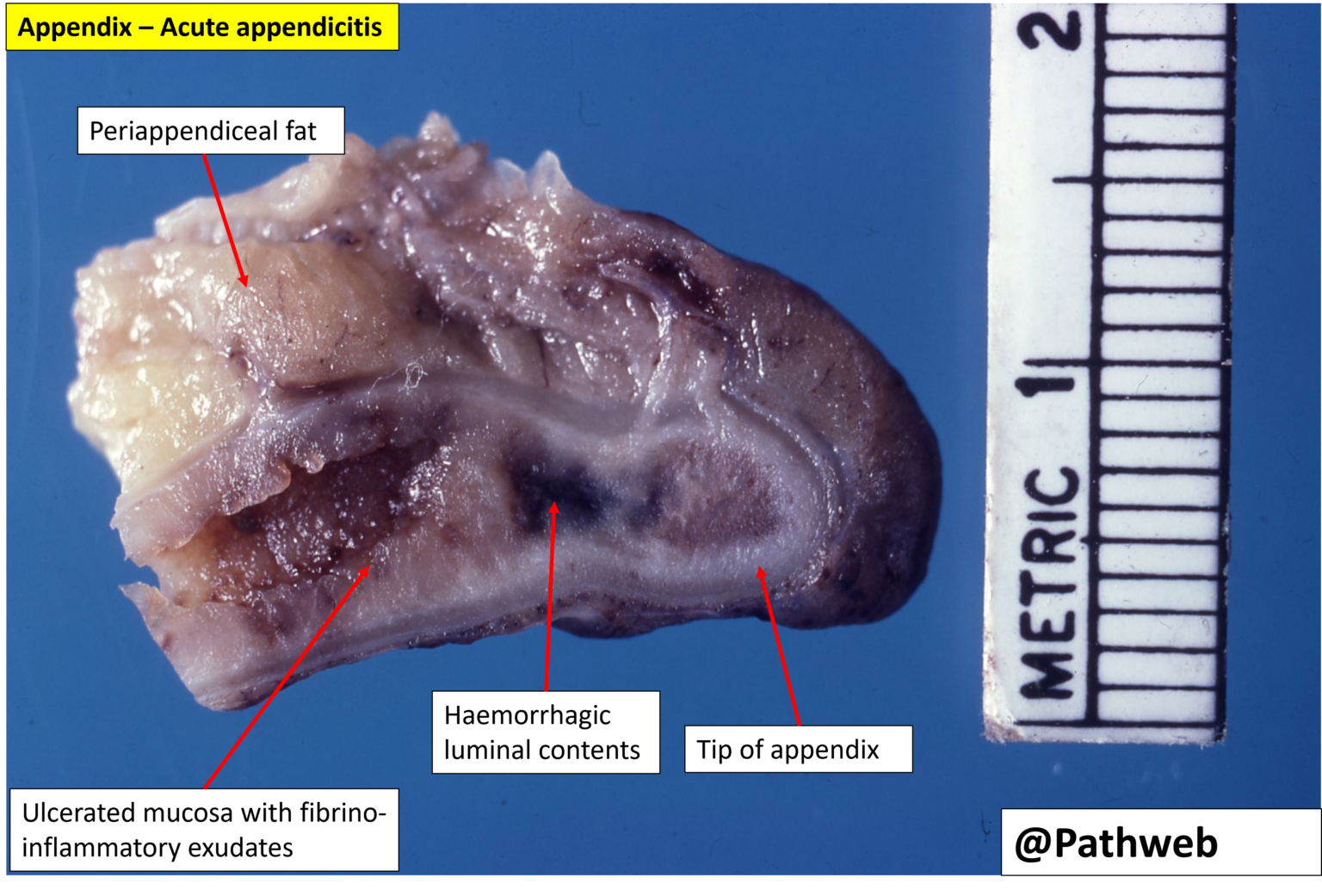 Appendix – Acute Appendicitis – NUS Pathweb :: NUS Pathweb