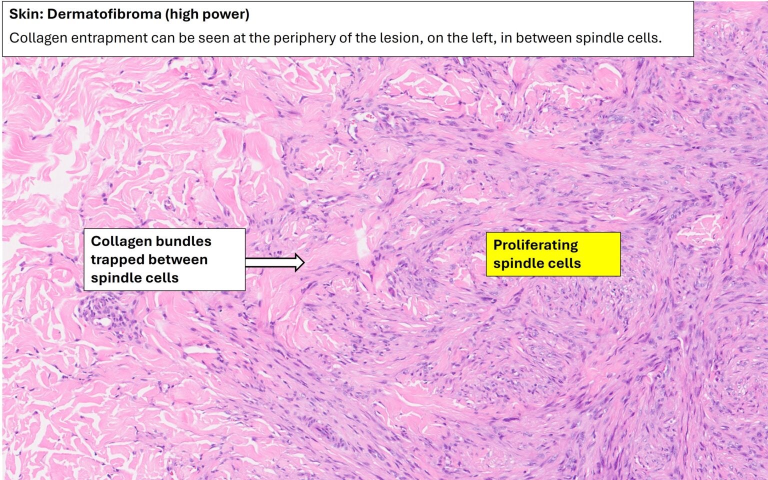 Skin – Dermatofibroma – NUS Pathweb :: NUS Pathweb