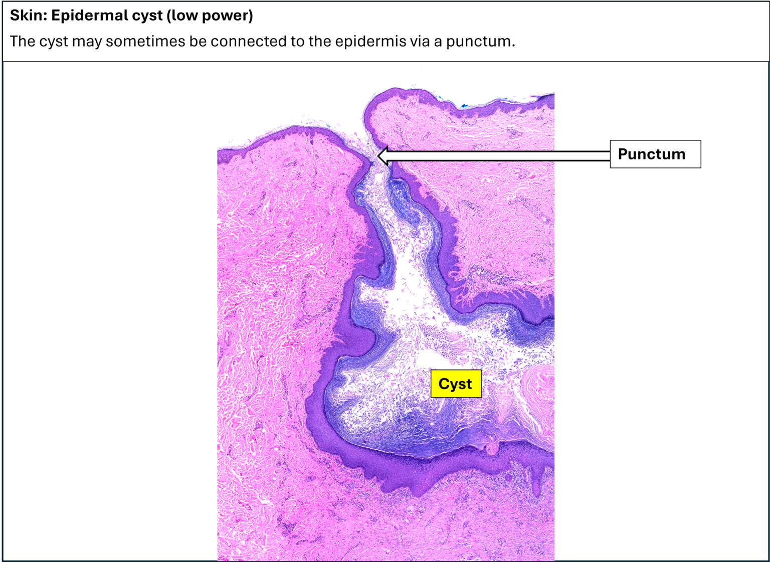 Skin – Epidermal cyst – NUS Pathweb :: NUS Pathweb
