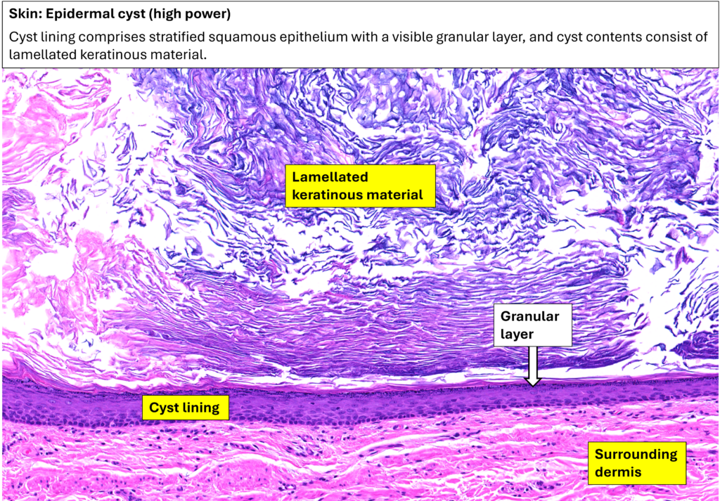 Skin – Epidermal cyst – NUS Pathweb :: NUS Pathweb