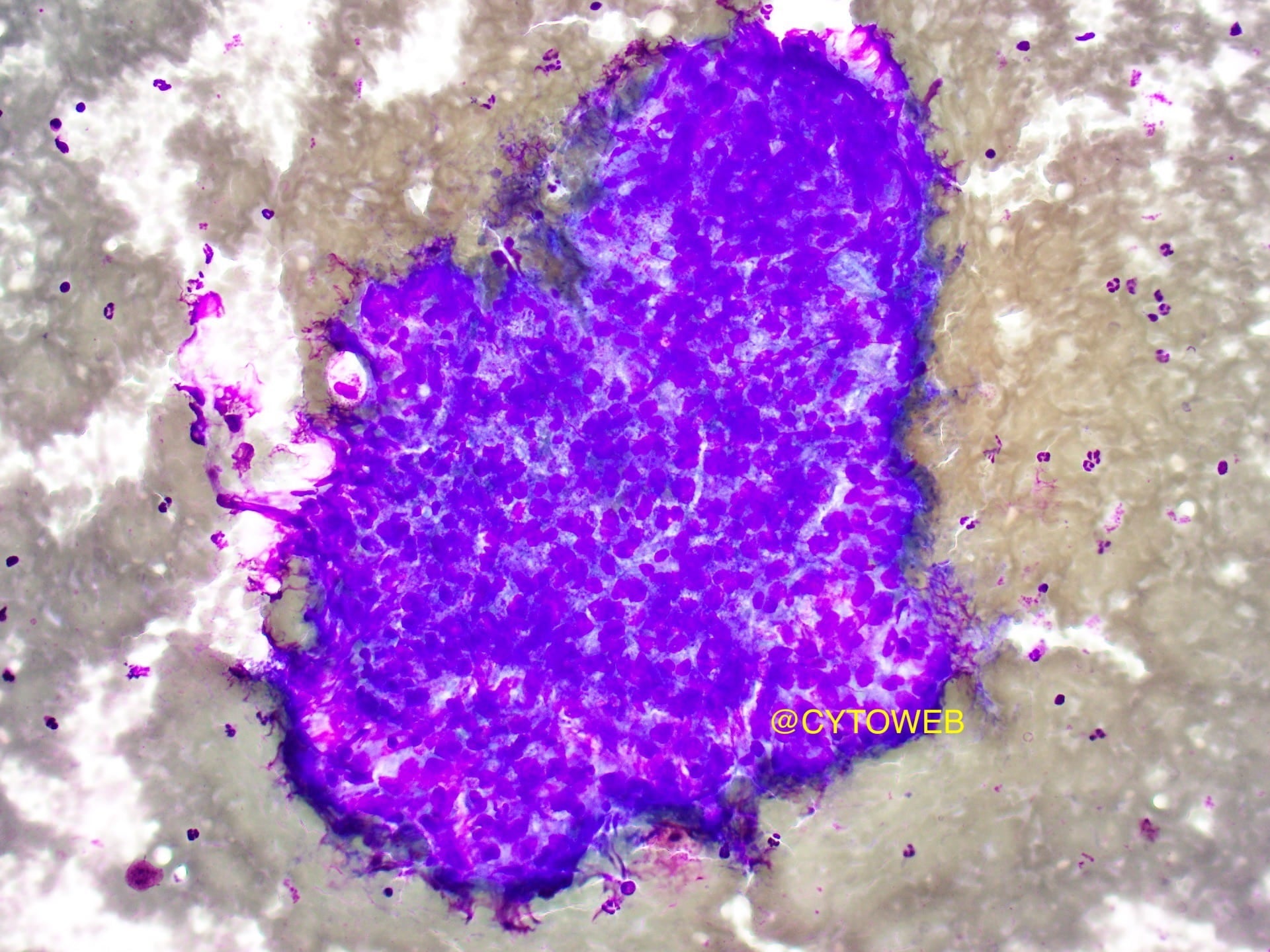 Lymph node case 2