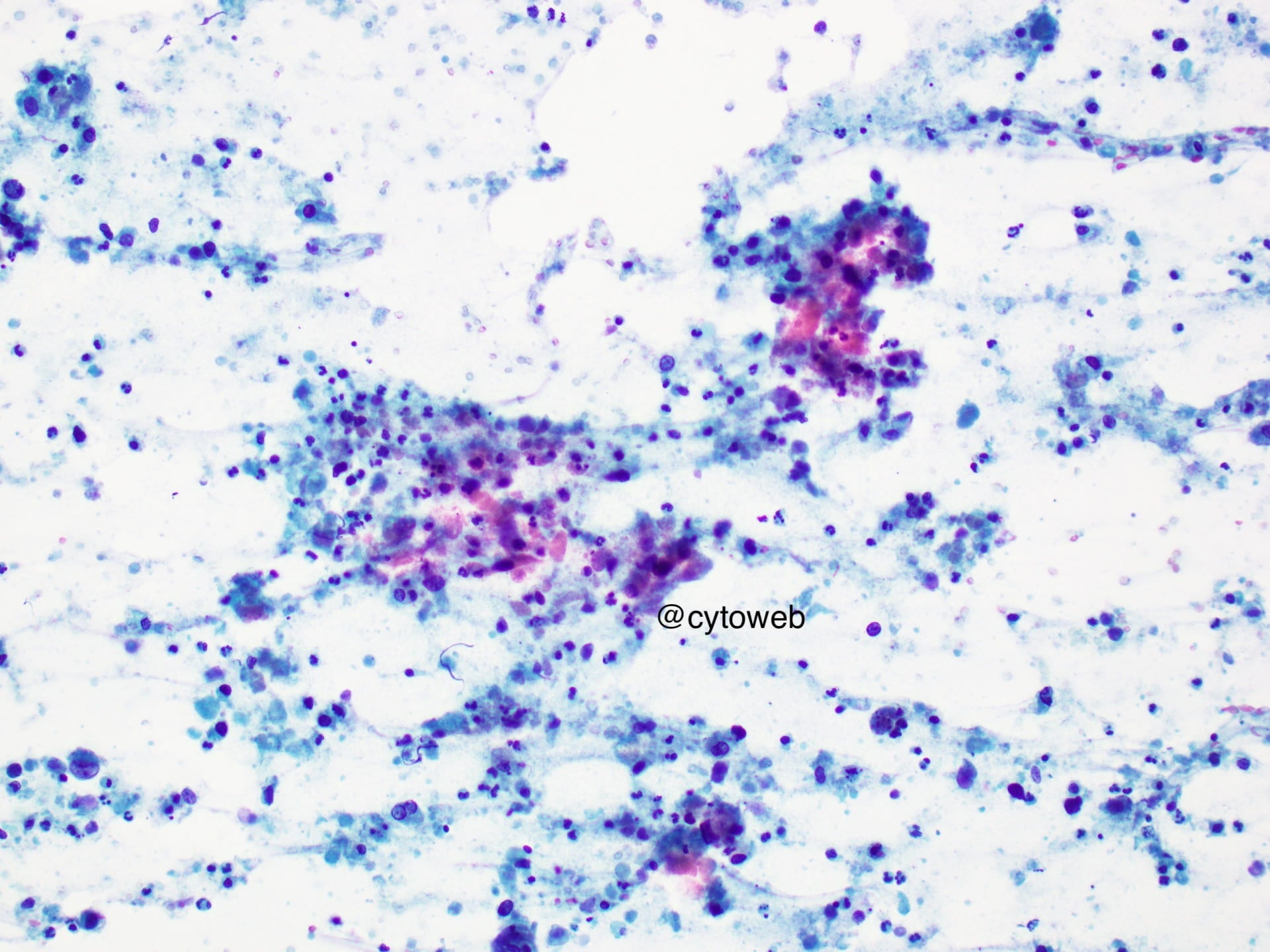 Salivary gland case 2