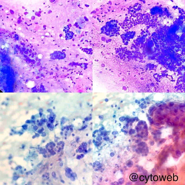 EUS-FNA 1