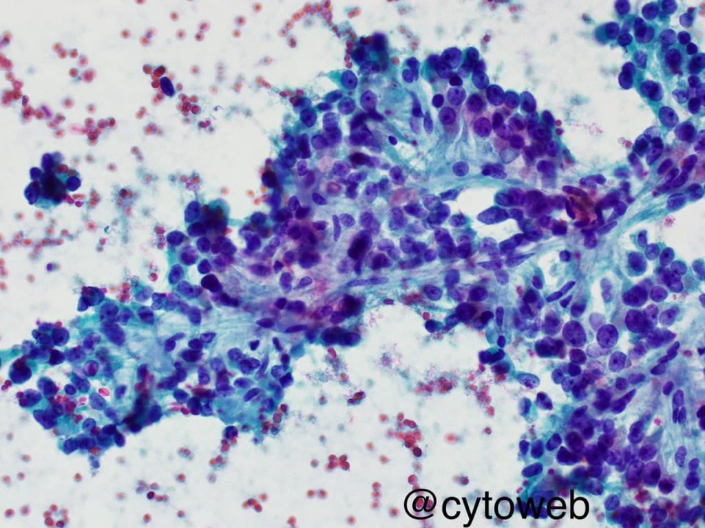 EUS-FNA case 4