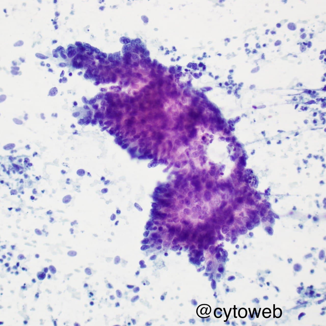 EUS-FNA case 5