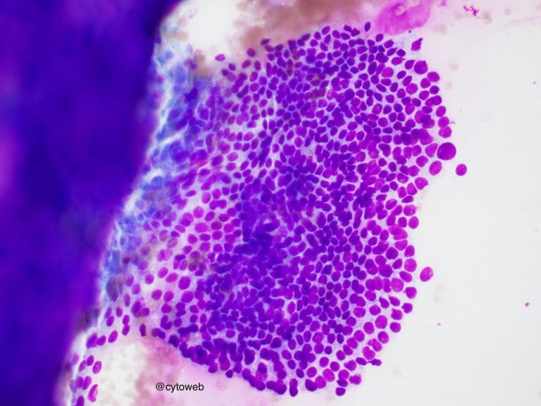 EUS-FNA case 3