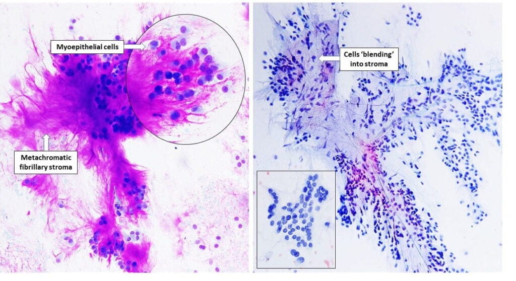 Picture Atlas – FNA: Salivary gland – NUS Pathweb :: NUS Pathweb