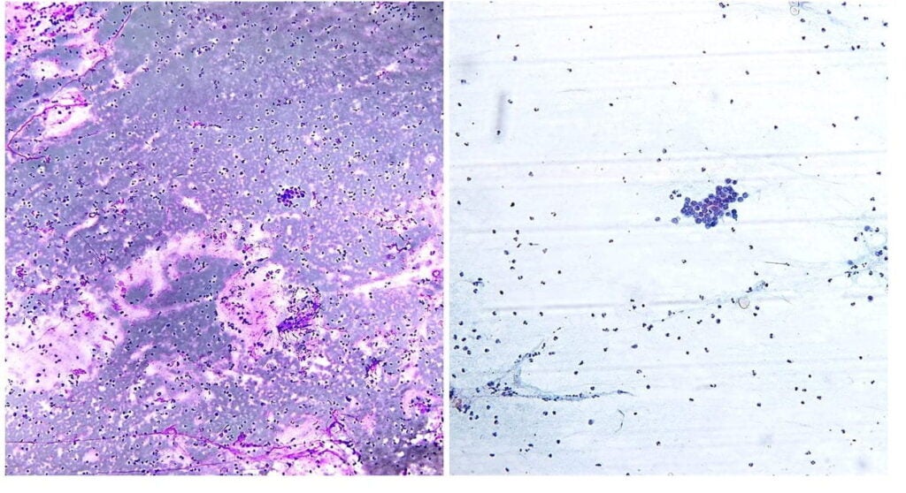 Picture Atlas – FNA: Salivary gland – NUS Pathweb :: NUS Pathweb