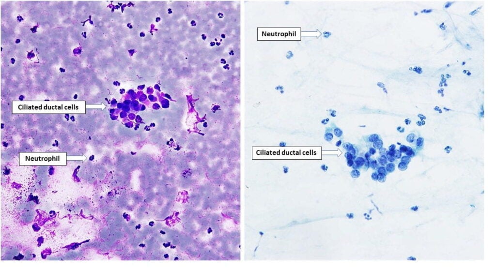 Picture Atlas – FNA: Salivary gland – NUS Pathweb :: NUS Pathweb
