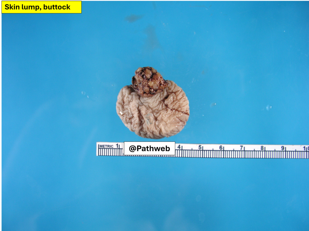 Butt_FibroepithelialP.1