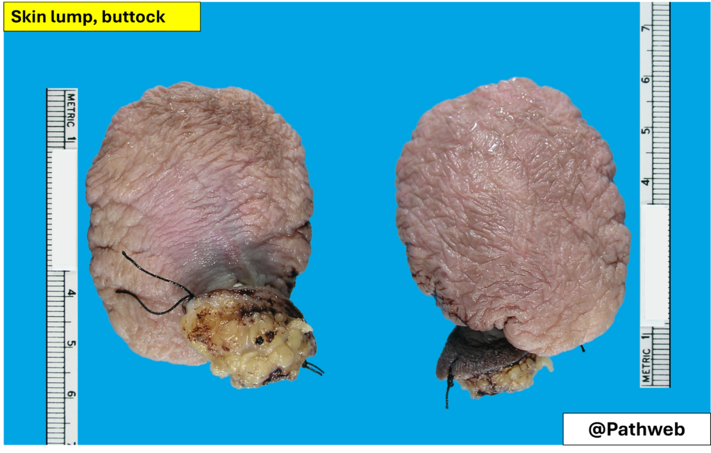 Butt_FibroepithelialP.2