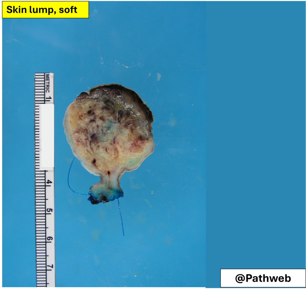 Skinlump_FibroepithelialP.1