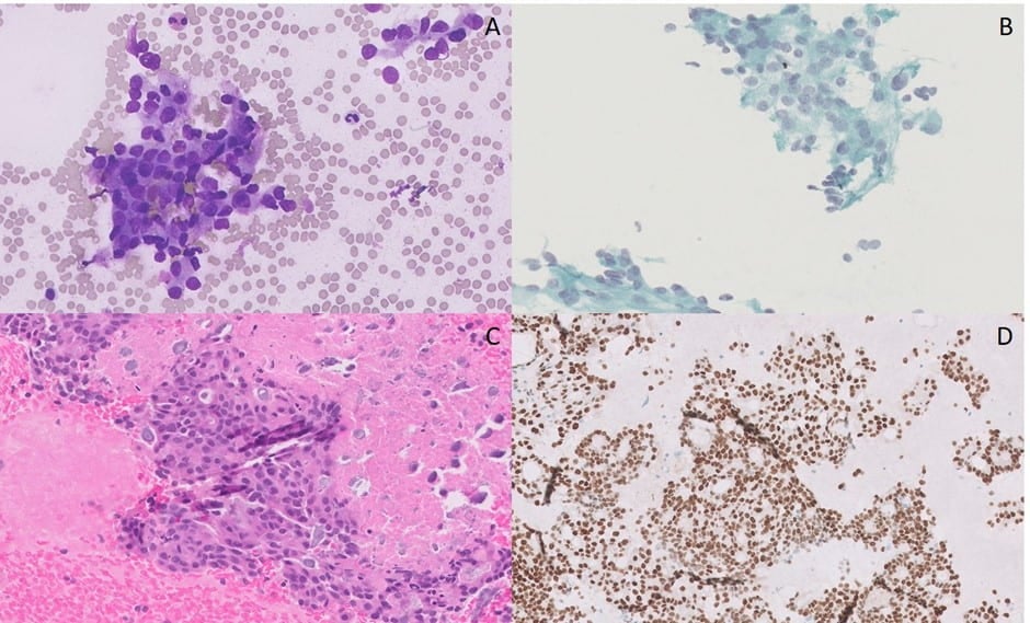 A: Diff-Quik, B: Pap,
C: H&E Cell Block, D: GATA3 immunoperoxidase