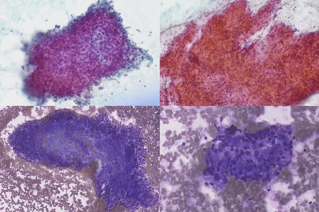 Upper row – Pap stain; Lower row – DQ stain
