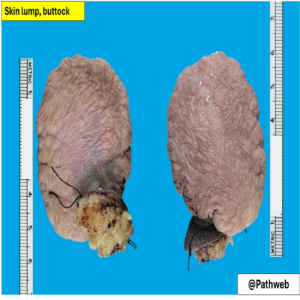 Butt_FibroepithelialP.2_icon