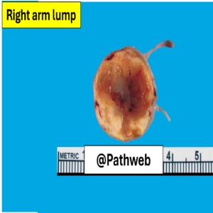 RtA_schwannoma.1_icon