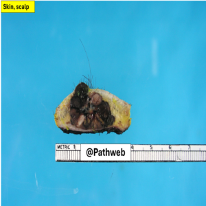 Scalp_Melanoma.1_icon