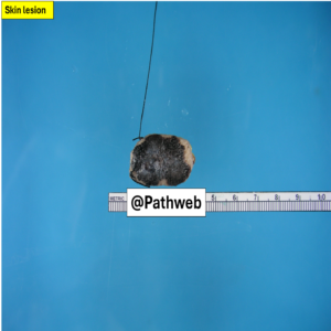 Skin_Melanoma.1_icon