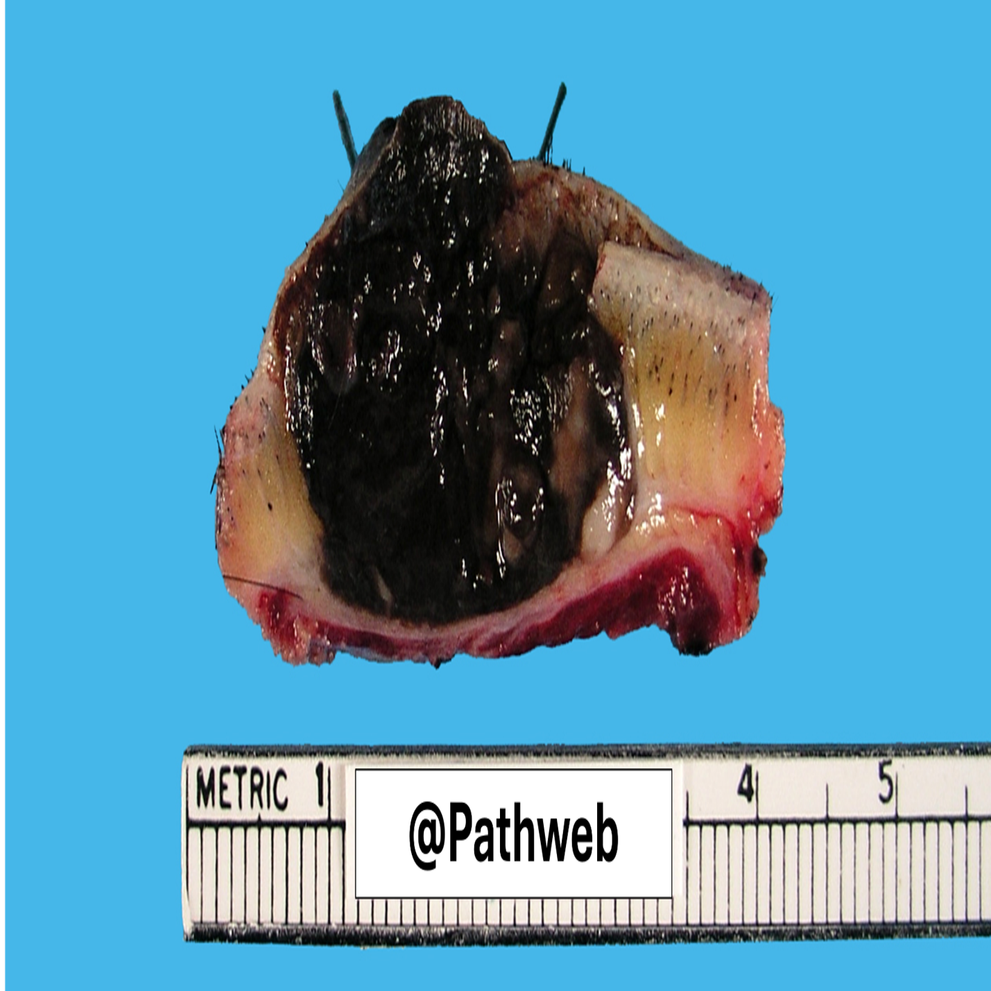 Skin_Melanoma.2_icon