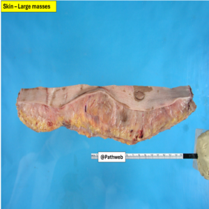 Skin_Neurofibroma.1_icon