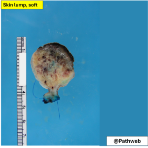 Skinlump_FibroepithelialP.1_icon
