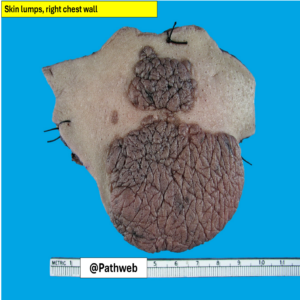 Skinlump_neurofibroma.1_icon