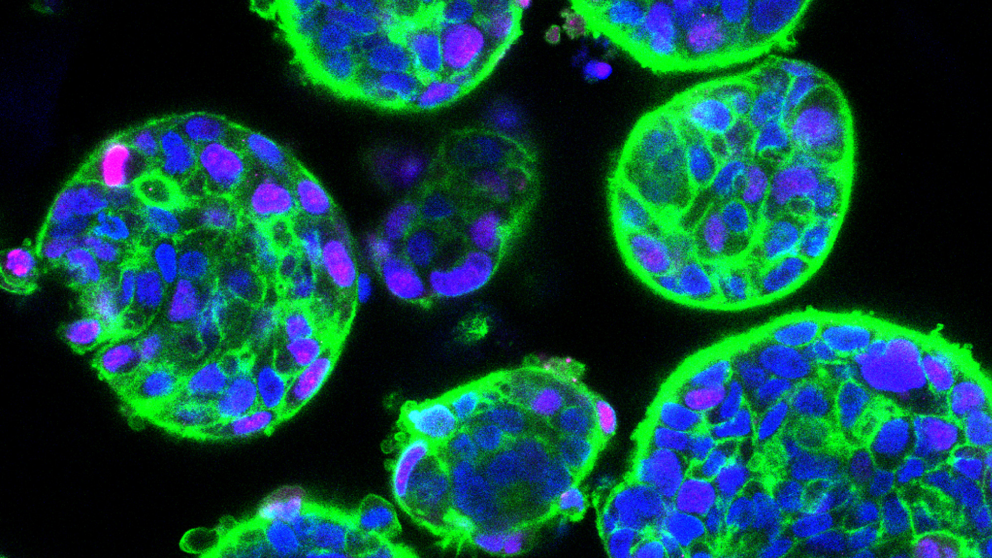 Recreating Liver Tumours as Organoids for Faster, More Accurate Drug