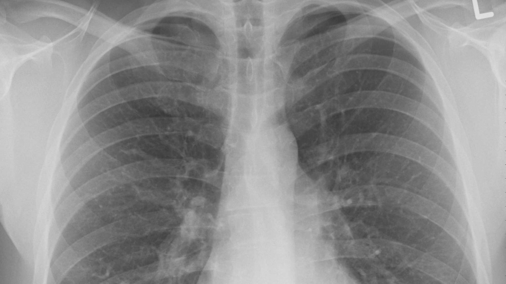 FAT HOPE: Enzyme in Fat Synthesis Interacts with a Lung Cancer Cell ...