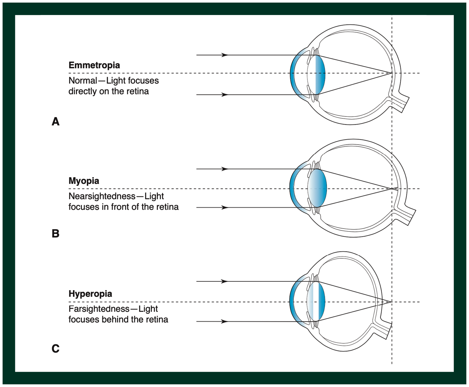 Diagram: The position of light rays focusing, depending on different refractive statuses of the human eye.