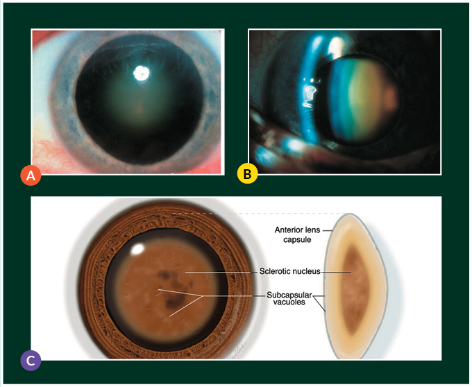 Diagram: Clinical photograph of a nuclear sclerotic cataract.