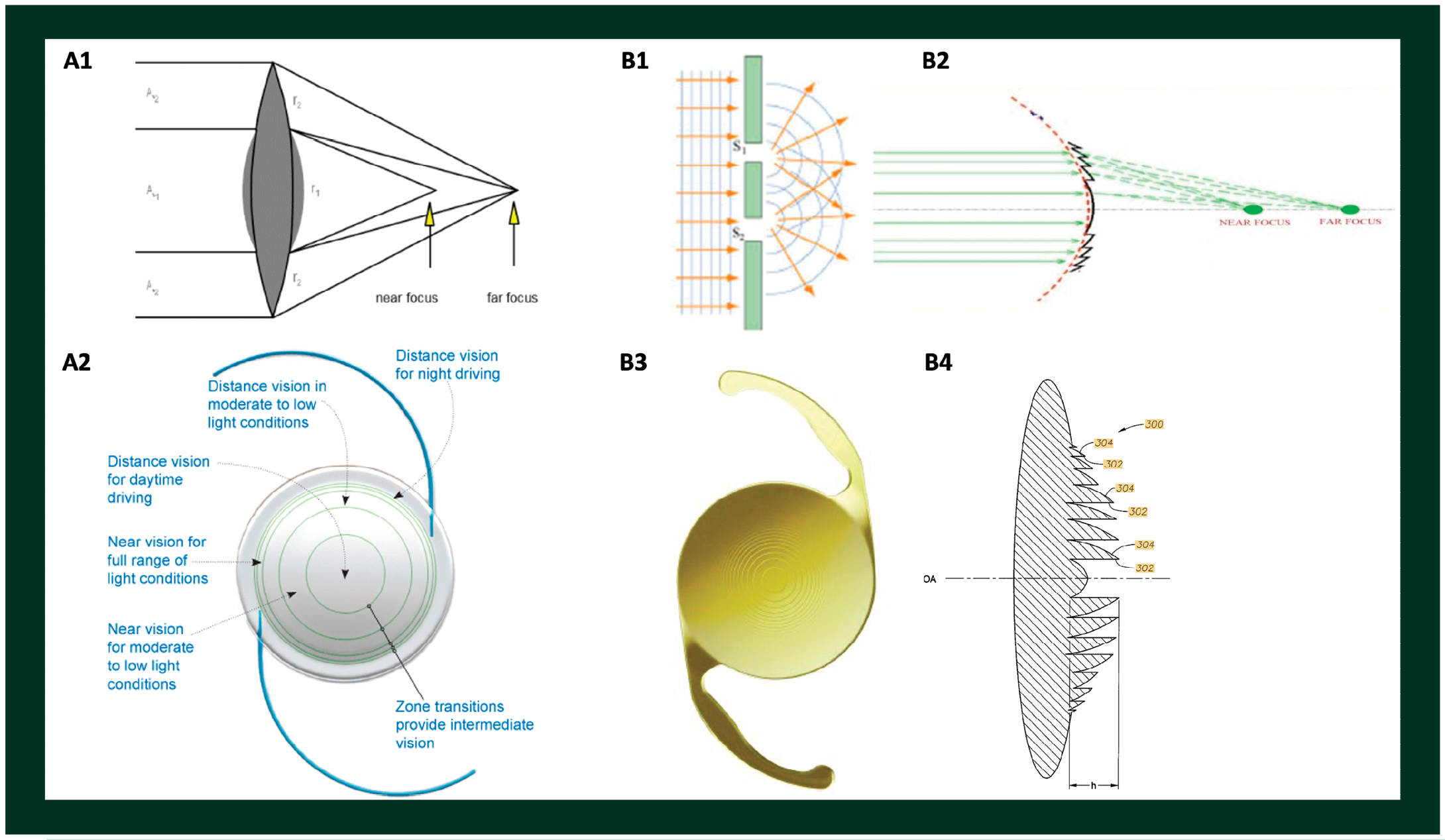 Schematics of different multifocal intraocular lens designs.